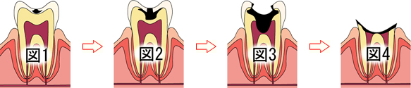 虫歯の痛み