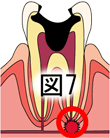 虫歯の痛み