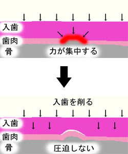 虫歯の痛み