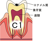 むし歯のおはなし