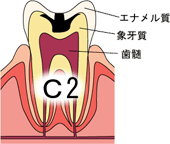 むし歯のおはなし