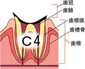 むし歯のおはなし