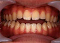 開咬の状態の歯並び