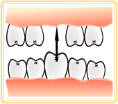 歯の無いところがあるときのイラスト
