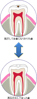 虫歯の痛み