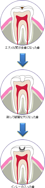 虫歯の痛み