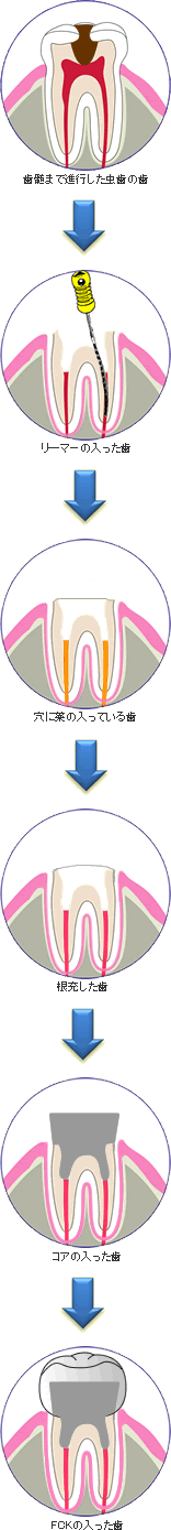 虫歯の痛み