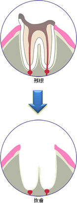 虫歯の痛み